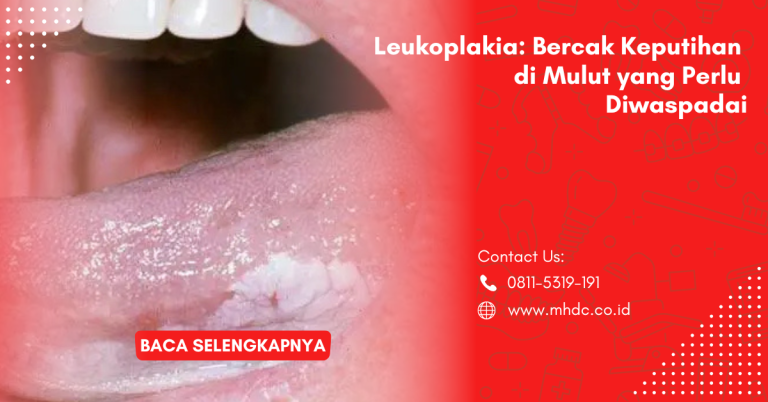 Leukoplakia: Bercak Keputihan di Mulut yang Perlu Diwaspadai