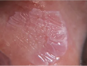 leukoplakia homogenik