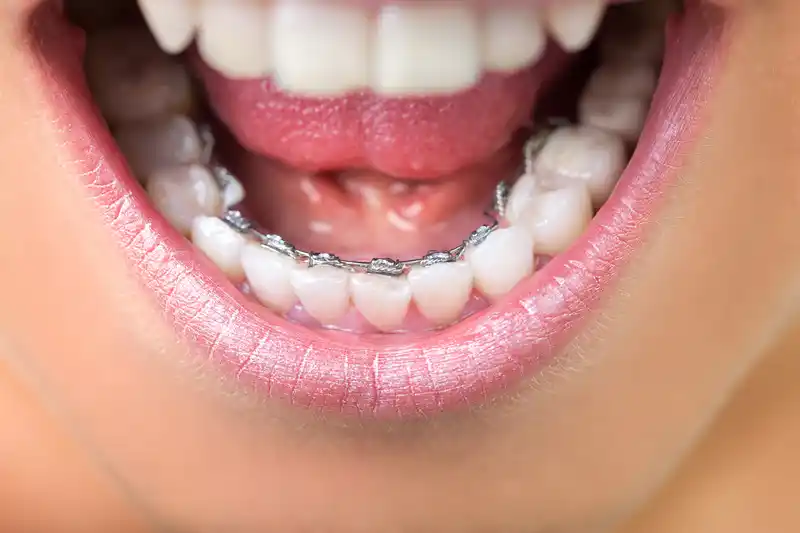 ortho behel