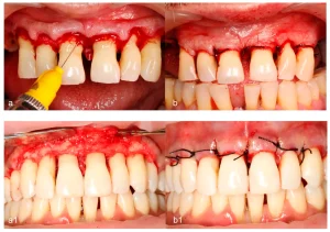 gingival flap surgery