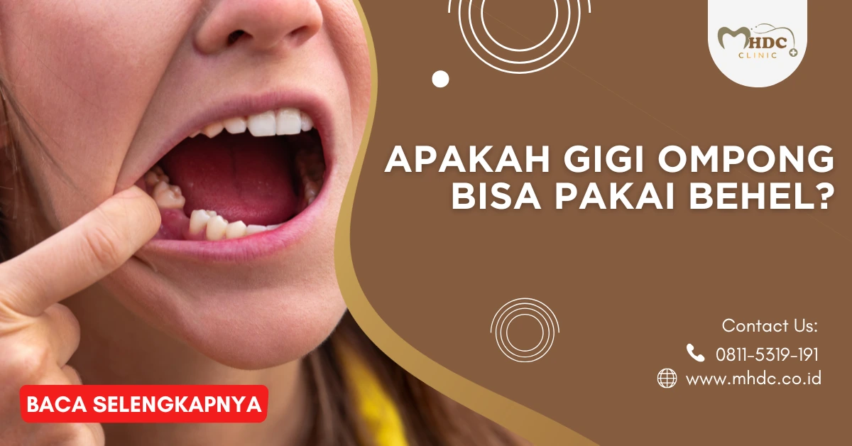 behel untuk merapatkan gigi ompong