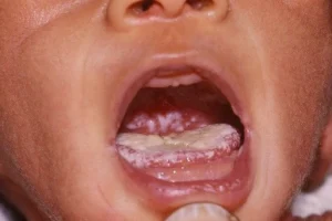 oral thrush bayi