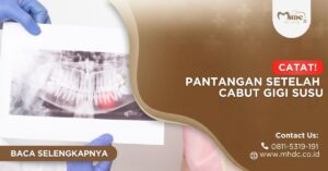 apa saja pantangan setelah operasi cabut gigi bungsu?
