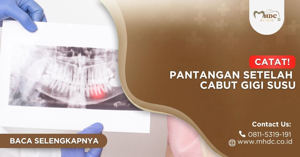 apa saja pantangan setelah operasi cabut gigi bungsu?