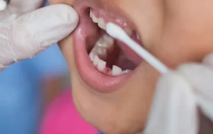 Aplikasi Vitamin Fluoride oleh Dokter Gigi
