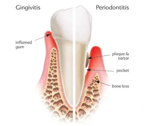gingivitis