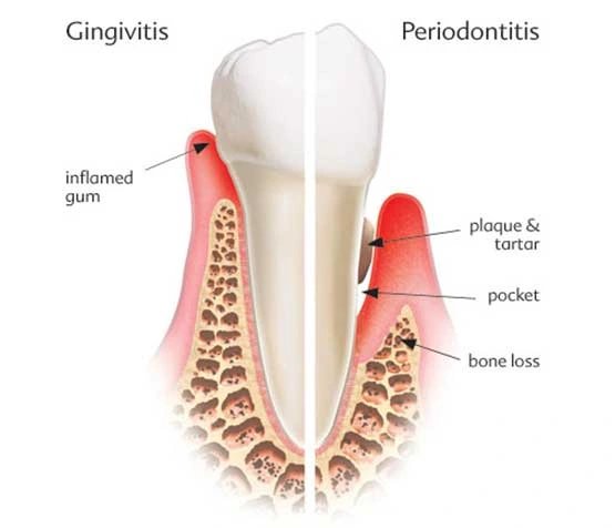 gingivitis