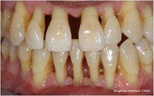 periodontitis adalah