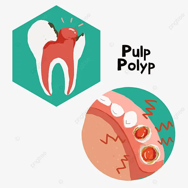 Ilustrasi polyp pulpa