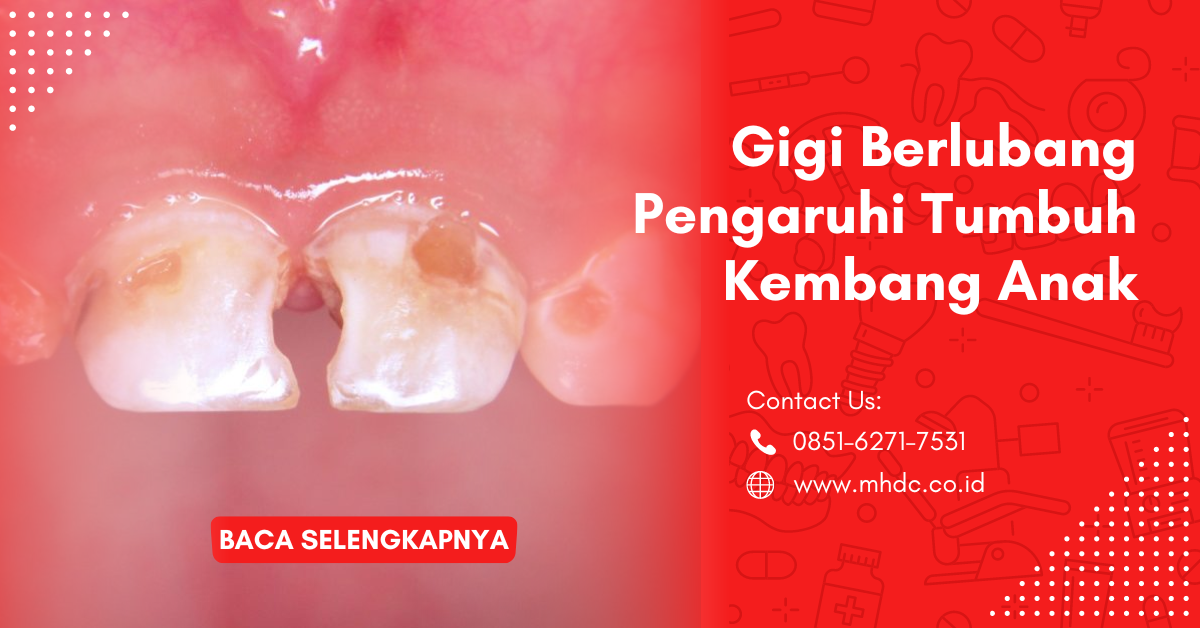 pola makan dan pengaruh gigi keropos