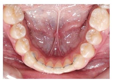 retainer gigi adalah