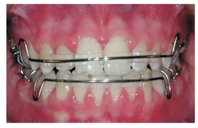 retainer lepasan