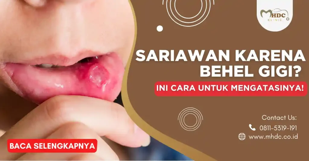 sariawan karena behel