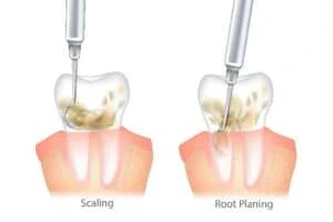 Scaling dan Root Planing