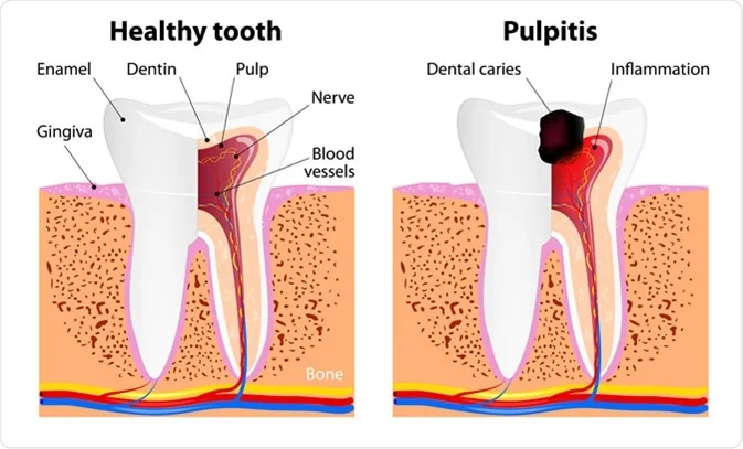 pulpitis adalah