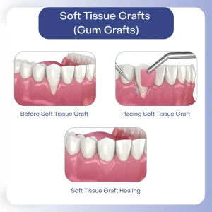 gum graft prosedur