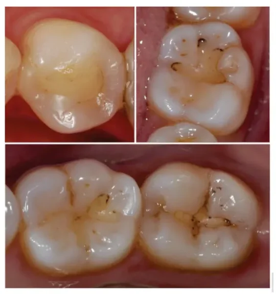Tambalan Gigi berubah warna tepian