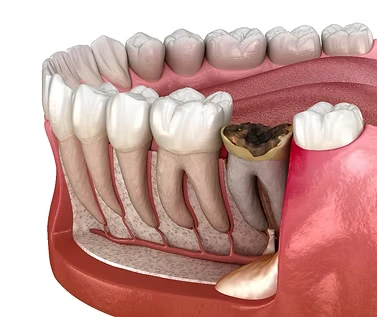 cabut akar gigi tertutup gusi
