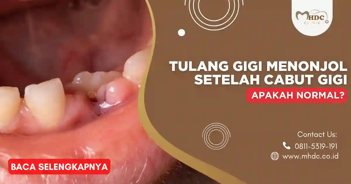 tulang gigi menonjol