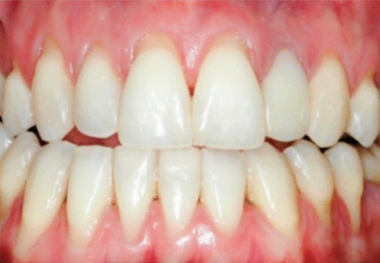 resesi gingiva