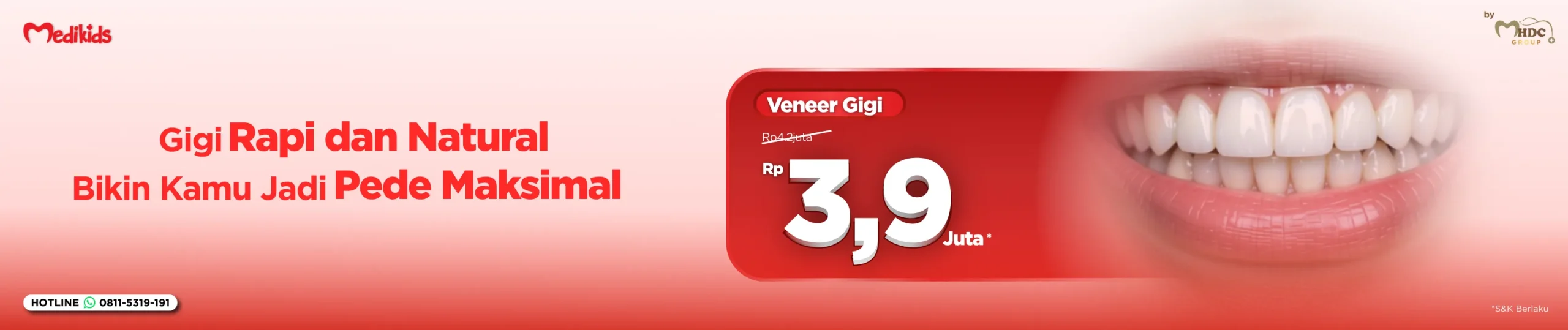 promo pasang veneer gigi di surabaya