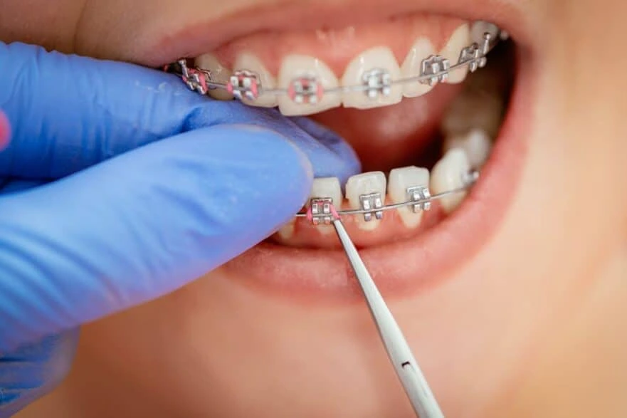 apa saja yang dilakukan saat kontrol behel