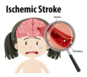 ischemic stroke ilustrasi