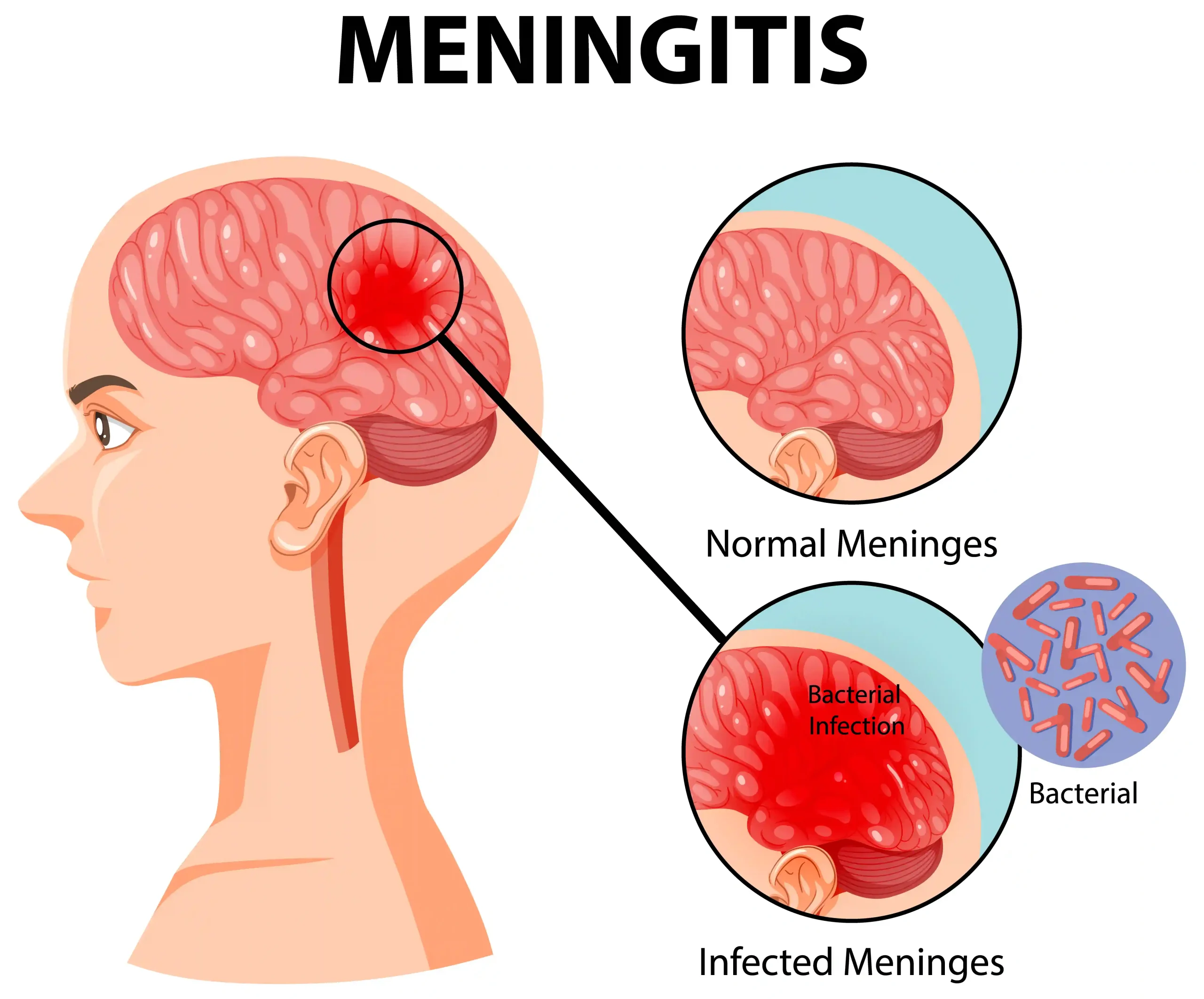 vaksin meningitis untuk umroh